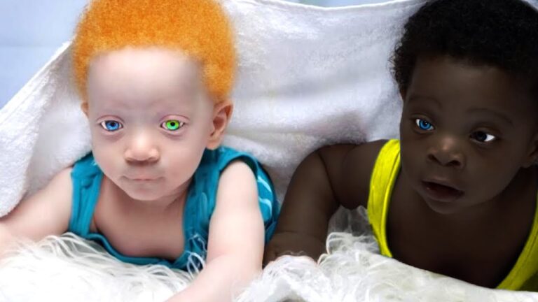 Remember The Black Twins With Different Colors? You Won’t Believe What Happened To Them!