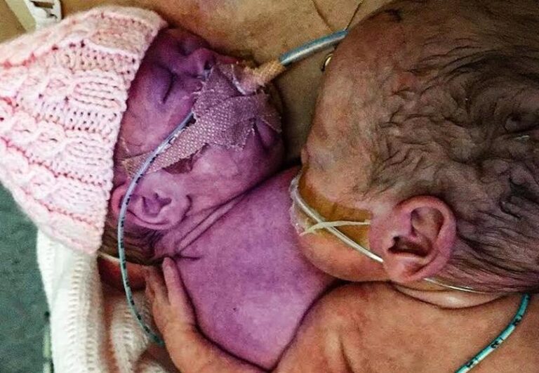 Doctors put newborn next to her dying sister, ‘what the baby did next left the doctors dazed’!