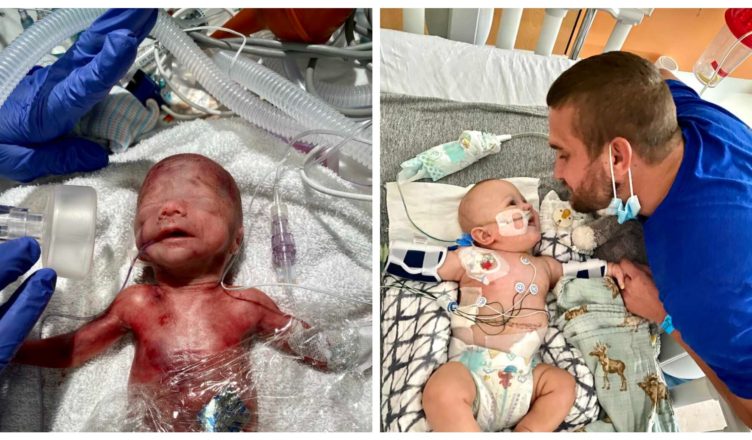 Born at just 1 pound and kept in the NICU for 113 days, this preemie is now a flourishing three‑year‑old
