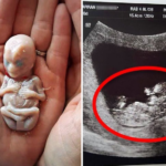 Mother delivers her baby — weeks later, doctors discover something else hidden inside