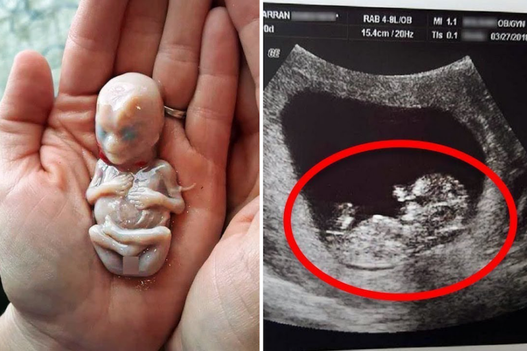 Mother delivers her baby — weeks later, doctors discover something else hidden inside