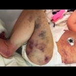 Mom Thought Son Was Stung By Wasp, Realizes Truth When He Turns Blue