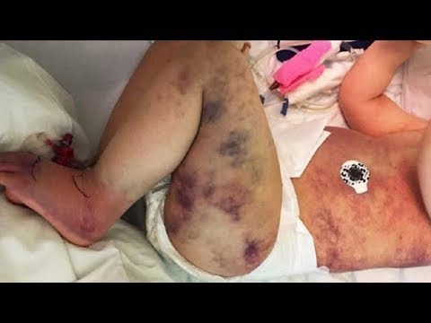 Mom Thought Son Was Stung By Wasp, Realizes Truth When He Turns Blue