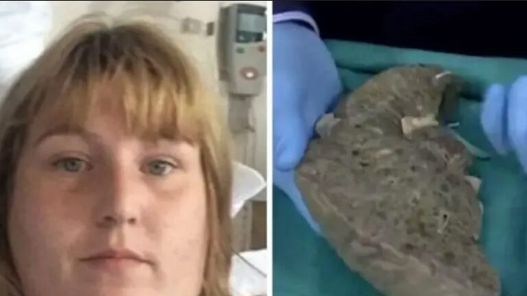 Red Bull habit damaged her liver so severely that doctors initially mistook her for an alcoholic