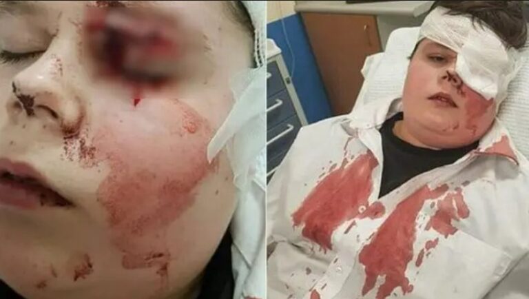 Boy Almost Blinded After Bully Smashes His Glasses Leaving Him Covered In Blood