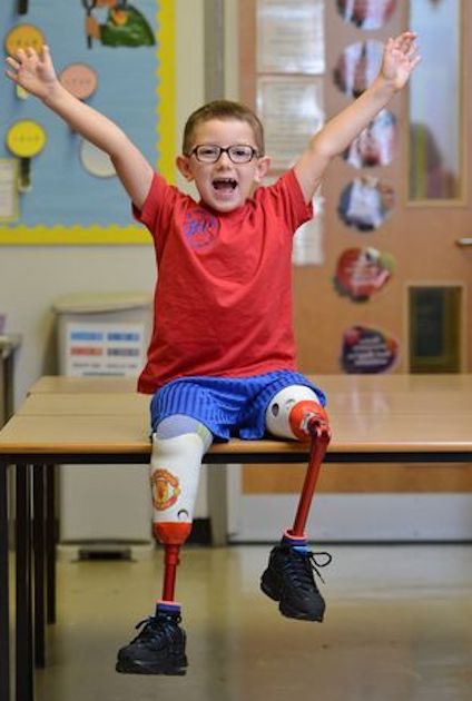 A boy who lost both legs struggled to get around — until a life‑changing moment transformed everything