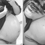 A mother’s belly kept growing long after birth — and doctors panicked when an ultrasound led them to ask her to sacrifice her baby