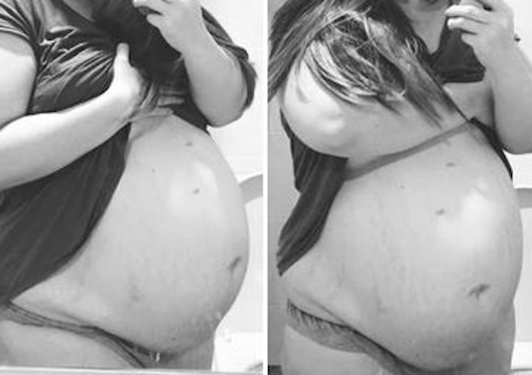 A mother’s belly kept growing long after birth — and doctors panicked when an ultrasound led them to ask her to sacrifice her baby