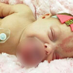 A Newborn Arrives With a Tongue Far Larger Than Expected — Doctors Step In With an Incredible Plan