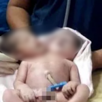 Baby Born With Two Heads, Three Arms, and Two Hearts — What Doctors Did Next Is Truly Astonishing
