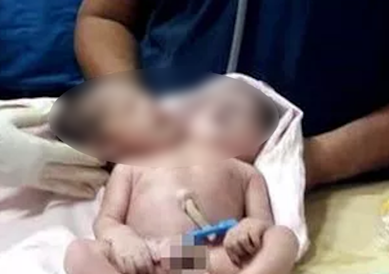 Baby Born With Two Heads, Three Arms, and Two Hearts — What Doctors Did Next Is Truly Astonishing