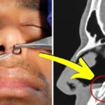 Doctors Investigate His Constant Nose Pain — What They Pull Out Is Truly Unbelievable