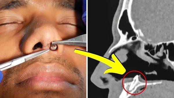 Doctors Investigate His Constant Nose Pain — What They Pull Out Is Truly Unbelievable