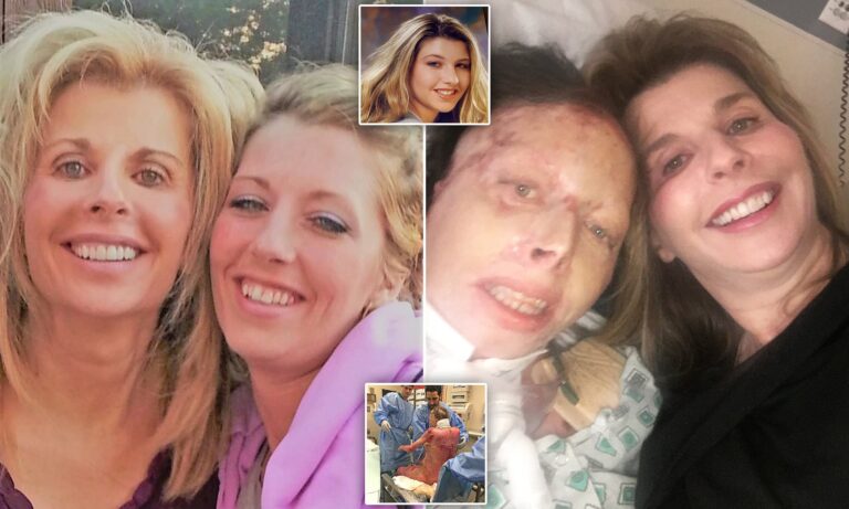Woman Brave Enough to Reveal Her Trauma After Being Set Ablaze by Her Boyfriend