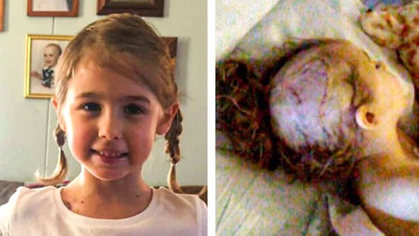 Go‑Kart Accident Leaves Young Girl Scalped, Prompting Her Parents to Issue a Serious Safety Alert